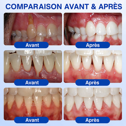 🦷Gel de réparation parodontale Healrize® GumRevive (pour les saignements et la rétraction des gencives ainsi que le déchaussement des dents)🐳