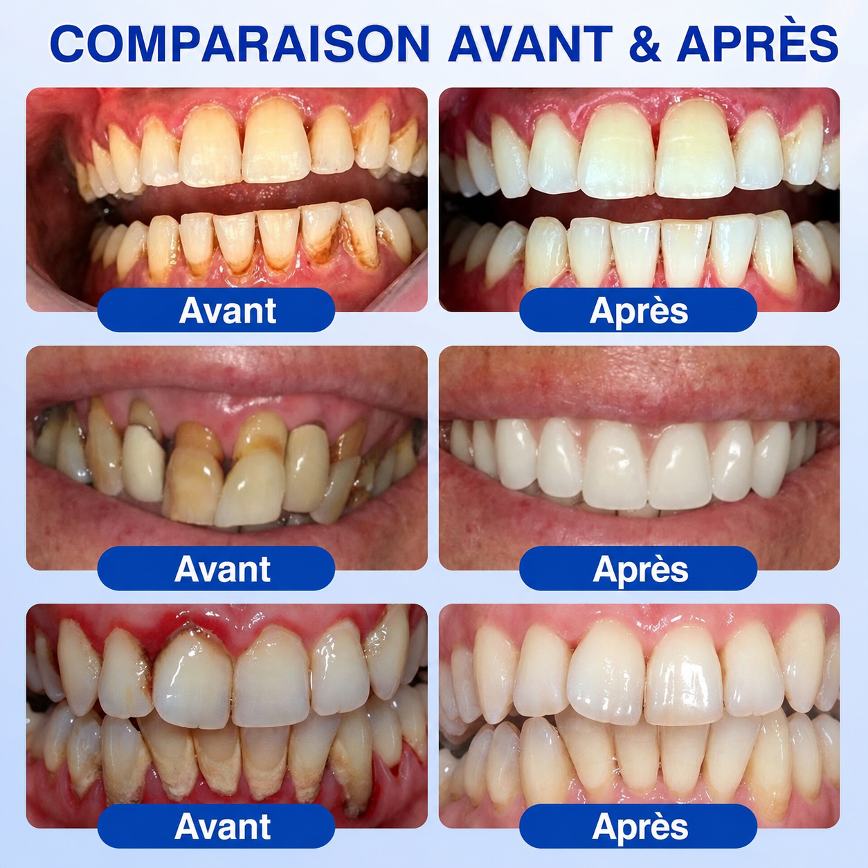 🦷Gel de réparation parodontale Healrize® GumRevive (pour les saignements et la rétraction des gencives ainsi que le déchaussement des dents)🐳